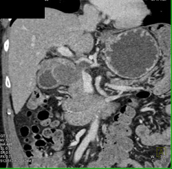 Pseudocyst - CTisus CT Scan