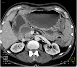 Pseudocyst - CTisus CT Scan