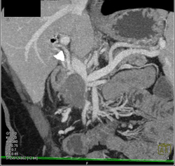 Pancreatic Adenocarcinoma Invades the PV/SMV - CTisus CT Scan