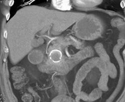 Pseudocyst - CTisus CT Scan