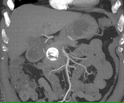 Pseudocyst - CTisus CT Scan