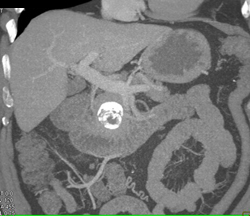 Pseudocyst - CTisus CT Scan