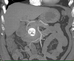 Pseudocyst - CTisus CT Scan