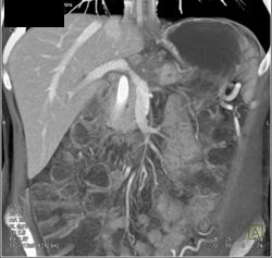 Occlusion of Splenic Vein By Pancreatic Cancer - CTisus CT Scan