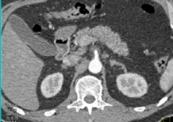 Subtle Tumor Infiltration of Celiac Artery - CTisus CT Scan