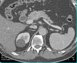 Pancreatic Islet Cell Tumor - CTisus CT Scan