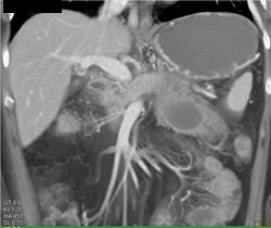 Infected Pseudocyst - CTisus CT Scan