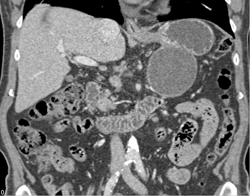 Pseudocyst S/P Distal Pancreatectomy and Splenectomy - CTisus CT Scan