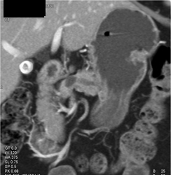 Central Intraductal Papillary Mucinous Neoplasm (IPMN) With Dilated Pancreatic Duct - CTisus CT Scan