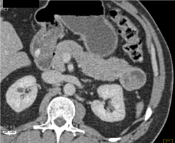 Cystic Lesion in Tail of the Pancreas - Islet Cell - CTisus CT Scan