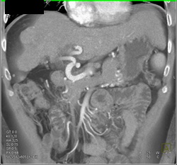 Huge Varices With Splenorenal Shunts Simulates Adenopathy - CTisus CT Scan