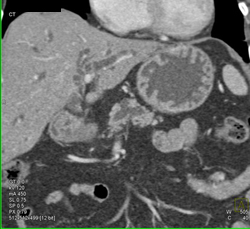 Intraductal Papillary Mucinous Neoplasm (IPMN) - CTisus CT Scan