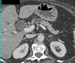 Intraductal Papillary Mucinous Neoplasm (IPMN) - CTisus CT Scan