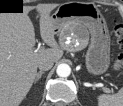 Islet Cell Tumor - CTisus CT Scan