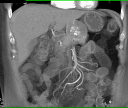 Islet Cell Tumor - CTisus CT Scan