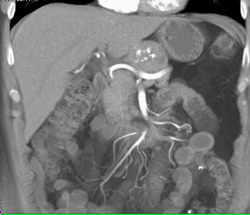 Islet Cell Tumor - CTisus CT Scan