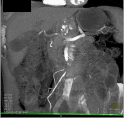 Islet Cell Tumor - CTisus CT Scan