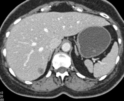 Pancreatic Cancer With Liver Metastases - CTisus CT Scan