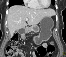 Pancreatic Cancer With Liver Metastases - CTisus CT Scan