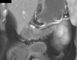 Pancreatic Cancer With Liver Metastases - CTisus CT Scan