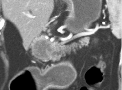 Pancreatic Cancer With Liver Metastases - CTisus CT Scan