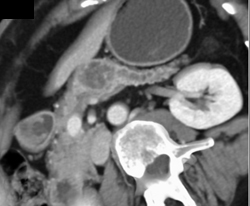 Pancreatic Cancer With Dilated Pancreatic Duct - CTisus CT Scan