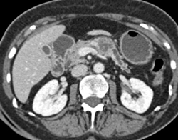 Pancreatic Cancer With Dilated Pancreatic Duct - CTisus CT Scan