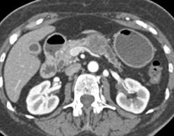 Pancreatic Cancer With Dilated Pancreatic Duct - CTisus CT Scan