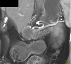 Pancreatic Cancer With Dilated Pancreatic Duct - CTisus CT Scan