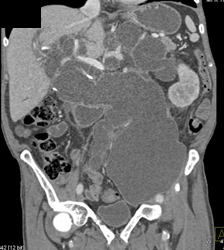 Multiple Cystic Lesions Due to Cystic Neoplasm Implanted Near Pancreas - CTisus CT Scan