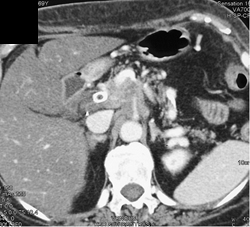 Pancreatic Cancer Encases Celiac, SMA, and PV - CTisus CT Scan