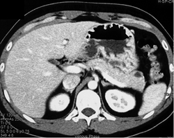 Intraductal Papillary Mucinous Neoplasm (IPMN) - CTisus CT Scan