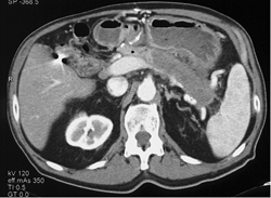 Tumor Infiltrates the Body and Tail of the Pancreas - CTisus CT Scan