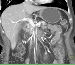 Superior Mesenteric Artery (SMA) Encased and Superior Mesenteric Vein (SMV) in Multiple Renderings - CTisus CT Scan