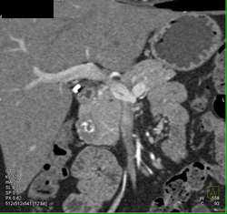 Islet Cell Tumor (glucagonoma) - CTisus CT Scan