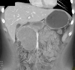 Hamoudi Tumor or a SPEN Tumor - CTisus CT Scan