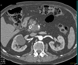 Adenocarcinoma of the Pancreas Involves the SMA - CTisus CT Scan