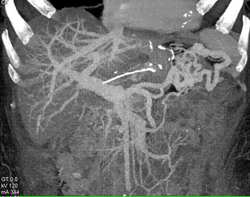 Encased Splenic Vein With Collaterals - CTisus CT Scan