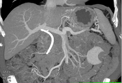 Stent in Common Bile Duct (CBD) in Patient With Pancreatic Cancer - CTisus CT Scan