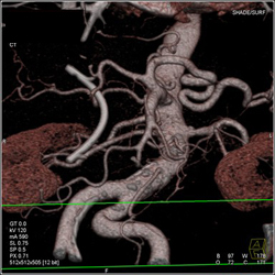 Accessory Right Hepatic Artery - CTisus CT Scan