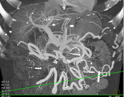 Occlusion of Superior Mesenteric Vein (SMV) Due to Pancreatic Cancer - CTisus CT Scan