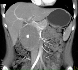 SPEN Tumor Or Hamoudi Tumor - CTisus CT Scan