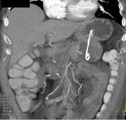 Stent From Stomach to Drain Pseudocyst - CTisus CT Scan