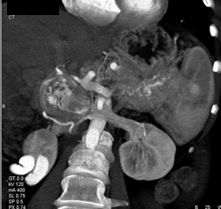 Islet Cell Tumor Encases the Splenic Artery With Collaterals - CTisus CT Scan