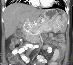 Infiltrating Islet Cell Encases the Spleen - CTisus CT Scan