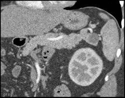 Intrapancreatic Splenic Tissue - CTisus CT Scan