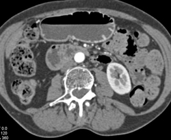 Ampullary Cancer - CTisus CT Scan