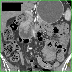 Ampullary Cancer - CTisus CT Scan