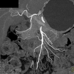 Ampullary Cancer - CTisus CT Scan