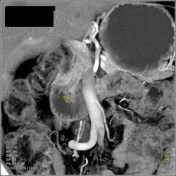 Ampullary Cancer - CTisus CT Scan